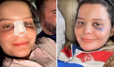 Maraisa mostra nariz quebrado após acidente em hotel: ‘Momentos conturbados’