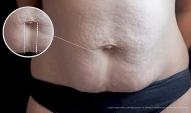 Diástase Abdominal: entenda as causas, complicações e novas soluções para uma vida com mais conforto