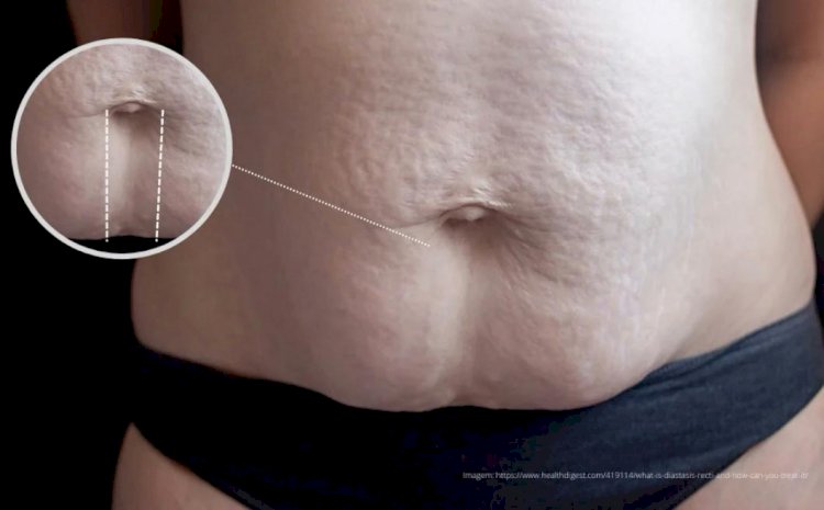 Diástase Abdominal: entenda as causas, complicações e novas soluções para uma vida com mais conforto